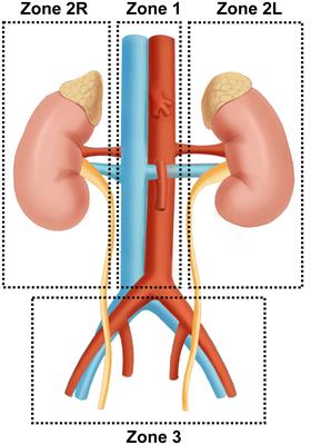 Surgical strategies of complicated pheochromocytomas/paragangliomas and literature review